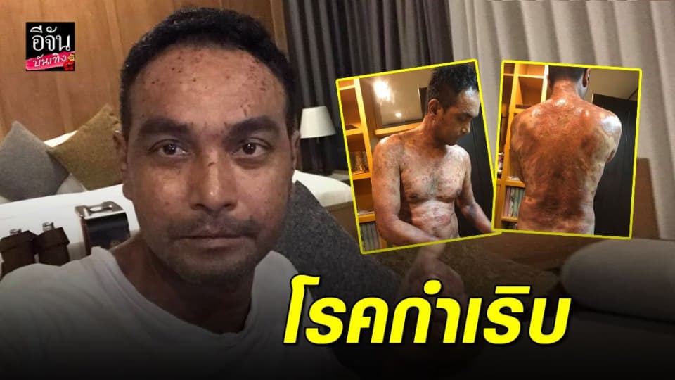 “เมฆ วินัย” เจอฝุ่น PM2.5 ทำพิษ โรคตุ่มน้ำพองกำเริบหนัก