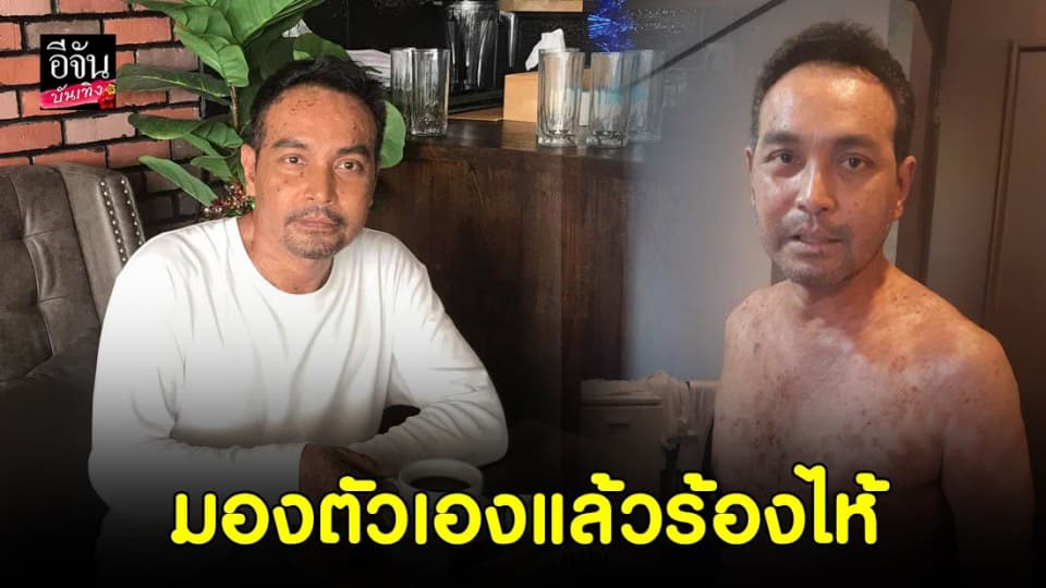 “เมฆ วินัย” เล่าย้อนตอนป่วยหนัก น้ำตาไหลยืนมองตัวเองหน้ากระจก มันเน่าไปหมด