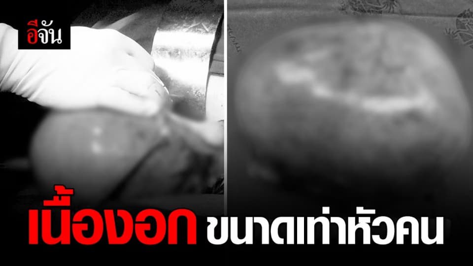พบเนื้องอกขนาด 20 ซม. อยู่ในท้องหญิงวัย 38 ปี