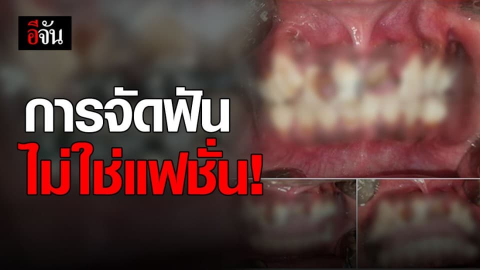 ขนลุก! จัดฟันแฟชั่น ฟันทะลุเป็นโพรง