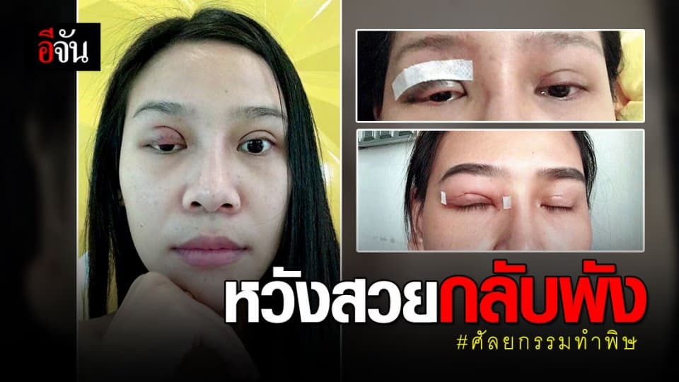 อุทาหรณ์ สาวทำตาสองชั้นแต่กลับพัง ดับฝันประกวดนางงามเวทีใหญ่