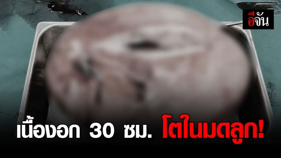 พบเนื้องอกขนาด 30 ซม. ในมดลูกสาว 33 ปี