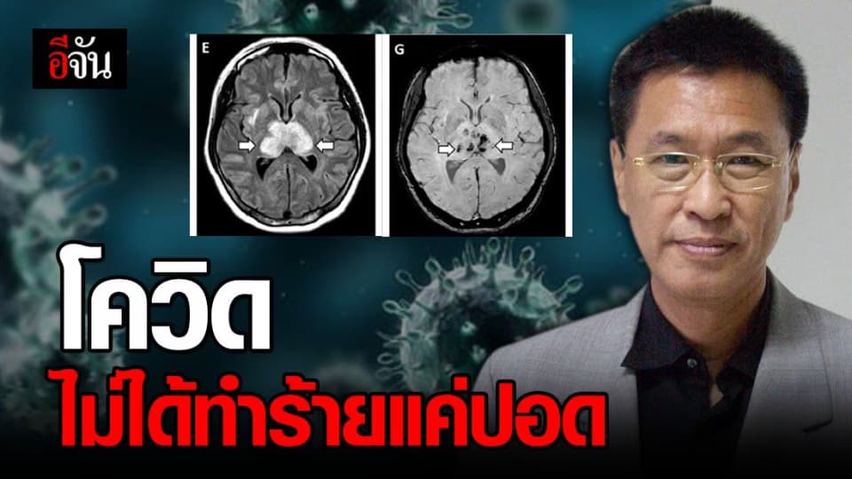 หมอชี้ โควิด-19 ไม่ได้ส่งผลแค่ปอด แต่มีผลต่อ สมองและหัวใจ ด้วย