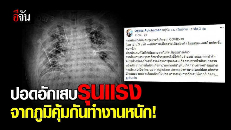 หมอโอภาส รพ.จุฬาฯ เผย อาการปอดอักเสบรุนแรง ส่วนหนึ่งมาจากภูมิคุ้มกันทำงานหนัก