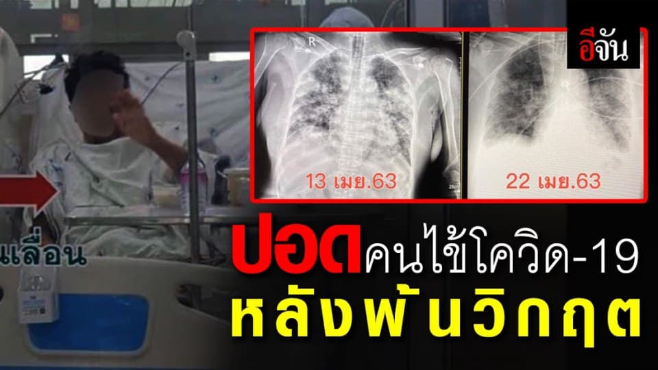 เผยภาพปอดผู้ป่วยโควิด-19 รายที่ 5 ของขอนแก่น หลังฟื้นตัวพ้นวิกฤต