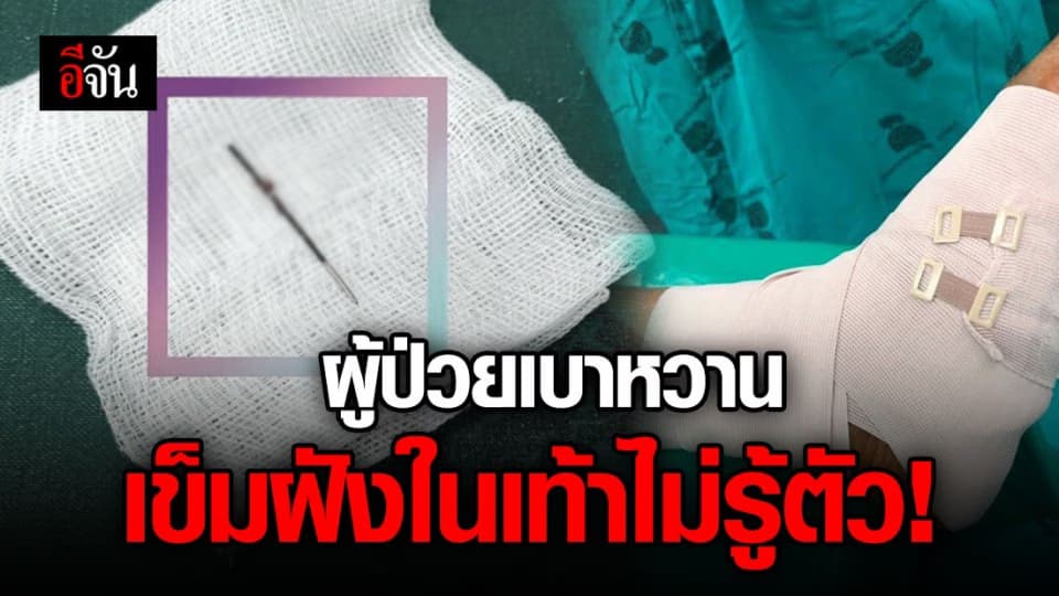 ผู้ป่วยเบาหวานเท้าชา เข็มเย็บผ้าตำเท้า ฝังในไม่รู้ตัว