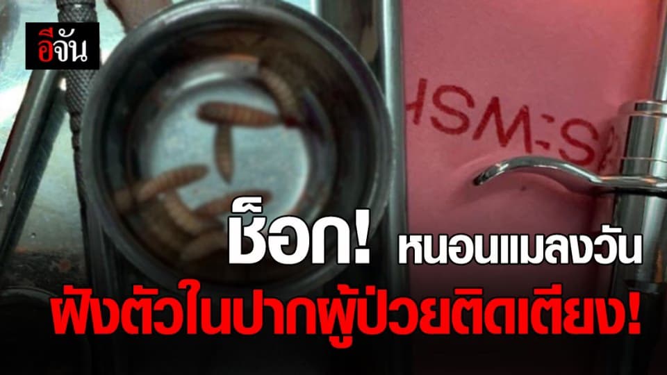 หนอนแมลงวัน 12 ตัว ฝังตัวอยู่ในผนังเพดานปาก ผู้ป่วยติดเตียง