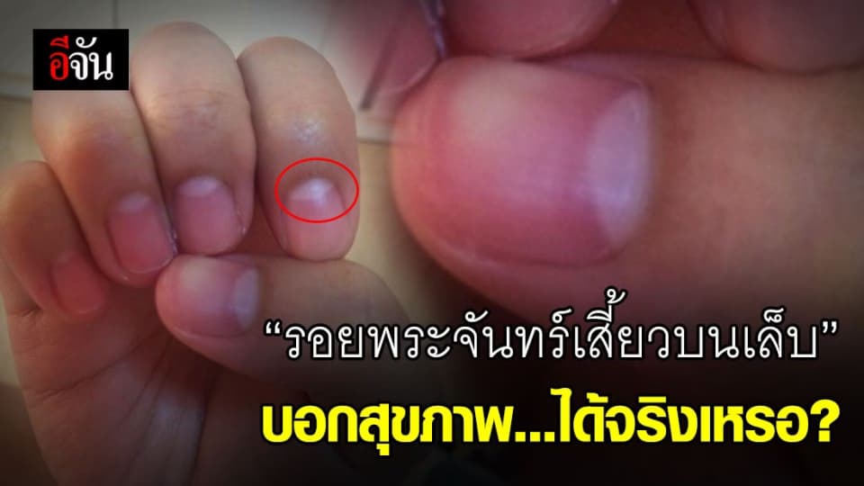 อย่าตื่นตระหนก รอยพระจันทร์เสี้ยวบนเล็บบอกสุขภาพ ชี้ จุดสังเกตอื่น
