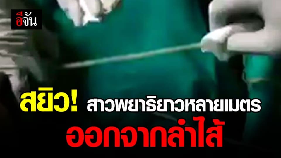 ทีมแพทย์สาวพยาธิยาวหลายเมตร ออกจากลำไส้คนไข้ที่ชอบกินดิบ