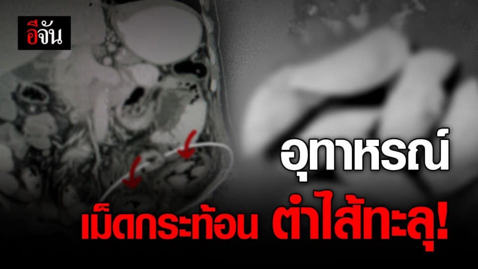 อุทาหรณ์ กลืนเม็ดกระท้อน อร่อยแต่อันตรายถึงชีวิต