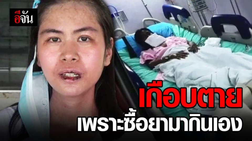 อุทาหรณ์! สาว 25 เกือบตาย หลังซื้อยามากินเองแล้วแพ้หนัก เพราะปวดฟันคุด