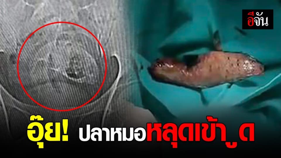 หนุ่มจีนปวดท้องปริศนา แพทย์ผงะ! พบปลาหมอหลุดเข้ารูทวาร