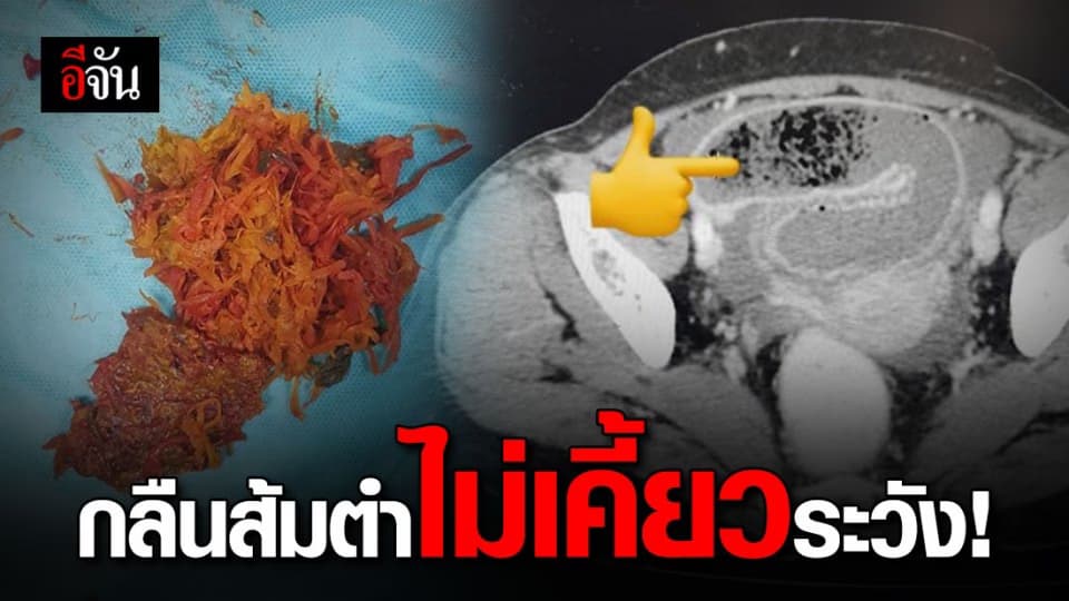 หมอเตือนกินส้มตำไม่เคี้ยว ทำลำไส้อุดตัน!