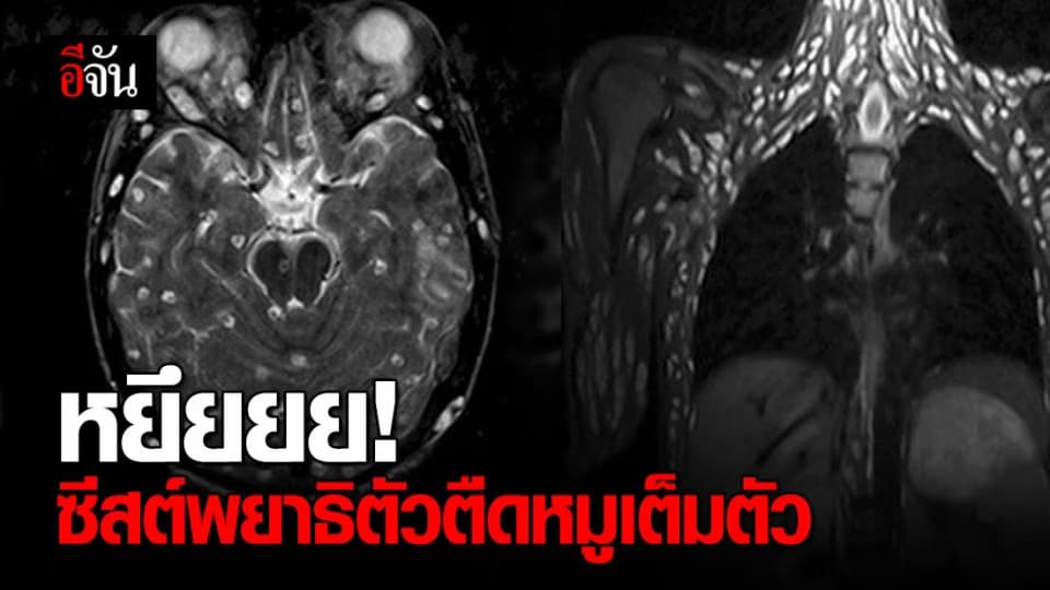 คนไข้วัย 18 มีพยาธิตัวตืดหมูเต็มตัว เตือนกินผักสดต้องระวัง!