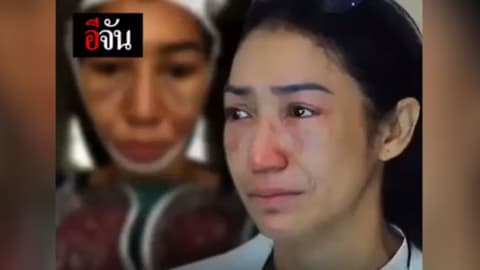 ฟิลเลอร์หน้า(หวัง)สวย แต่โป๊ะ