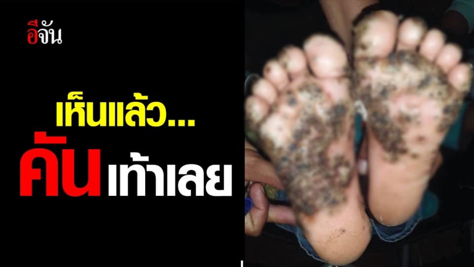 เหตุการณ์นี้เกิดที่บราซิล! เด็กเดินไม่สวมรองเท้า เจอหมัดไชเข้าผิวหนัง เป็นตุ่มอักเสบ