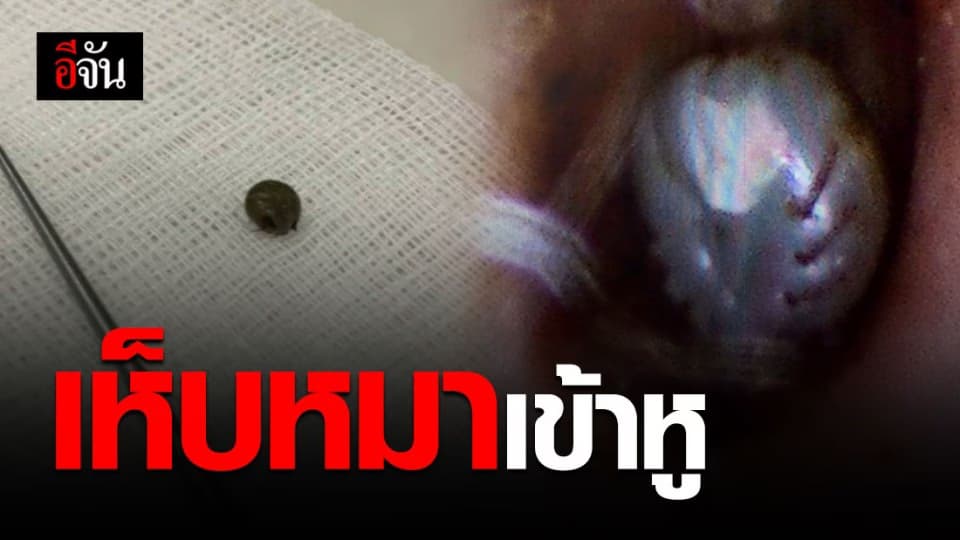 ช็อก! เจอเห็บหมาในหู คนไข้ปวดทรมาน โชคดีหมอเอาออกทัน