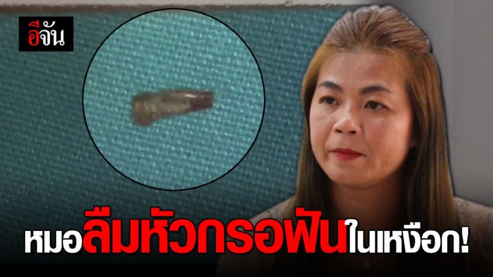 สาวร้อยเอ็ดเตรียมยื่นฟ้องเอาผิดปลัด สธ. กรณีหมอลืมหัวกรอฟันไว้ในเหงือก