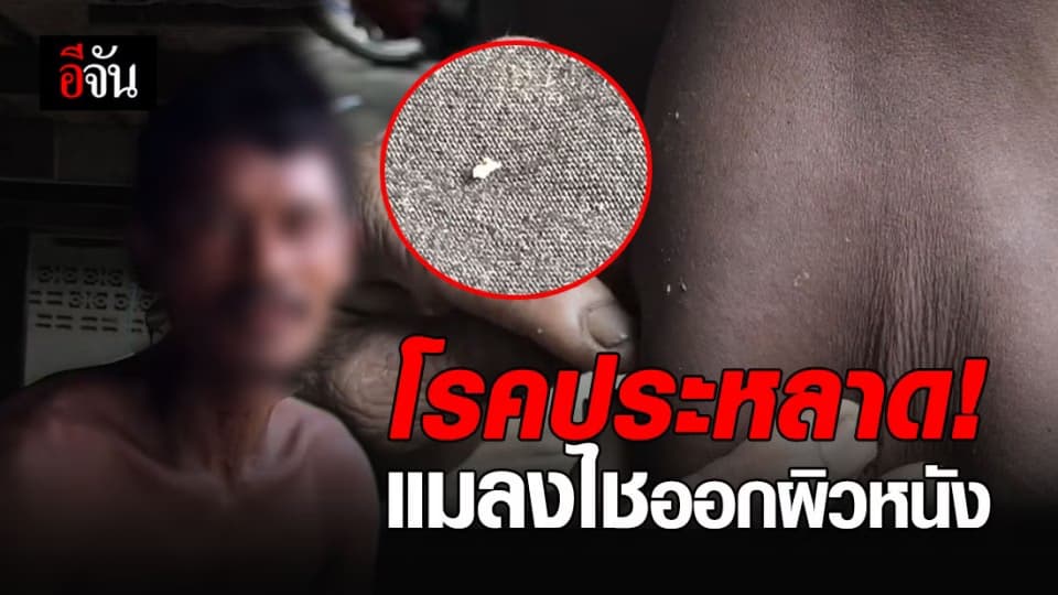 2 ยาย-หลาน ชาวอ่างทอง เกิดอาการแปลก มีหนอนไชออกจากผิวหนัง