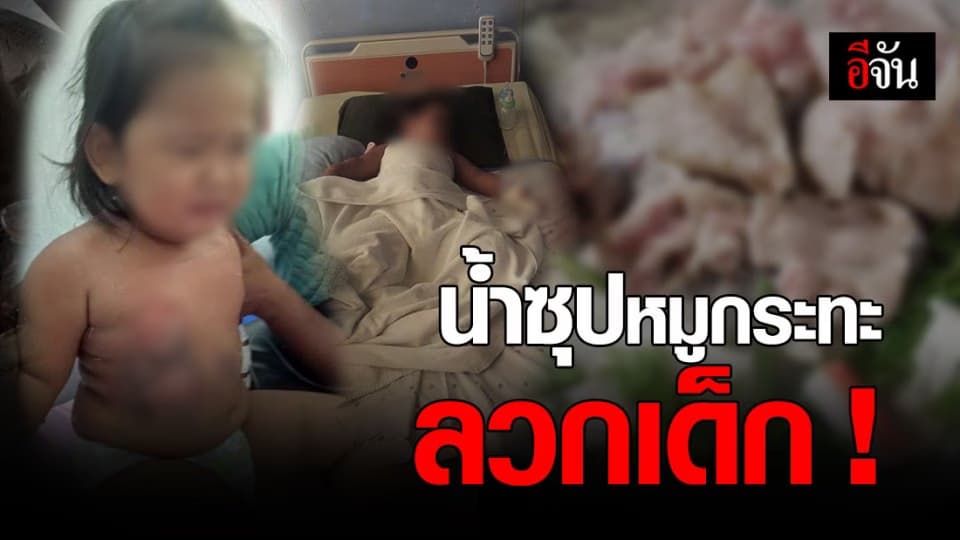 สงสารเด็กน้อย ! ถูกน้ำซุปหมูกระทะลวก บาดเจ็บหนัก