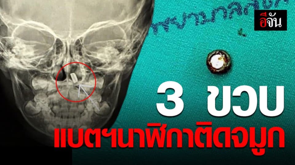 อุทาหรณ์คุณแม่คิดว่าลูกเป็นหวัด ที่แท้แบตฯ นาฬิกาติดจมูก!