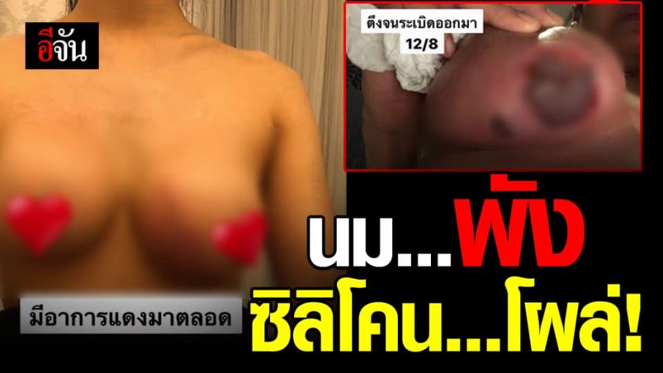 ศัลยกรรมทำพิษ! เสริมหน้าอกกับคลินิกดัง แต่อักเสบ จนสุดท้ายซิลิโคนโผล่