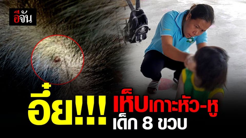 ครูถึงกับผงะ! ลูกศิษย์วัย 8 ขวบ ถูกเห็บสุนัขเกาะที่หัว-ในรูหูอื้อ!!!
