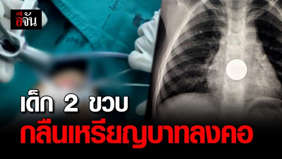 อุทาหรณ์พ่อแม่ ! เด็ก 2 ขวบ กลืนเหรียญบาทลงคอ ค้างในหลอดอาหารส่วนปลาย