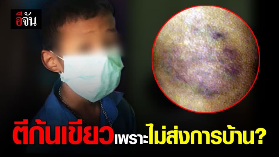 ผู้ปกครอง บุกโรงเรียน จ.ระยอง รับไม่ได้ลูกถูกตีก้นเขียวช้ำเพราะไม่ส่งการบ้านคณิต ?