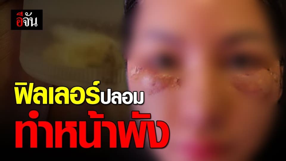 สาวโพสต์อุทาหรณ์ หน้าพังเพราะฟิลเลอร์ (ปลอม)