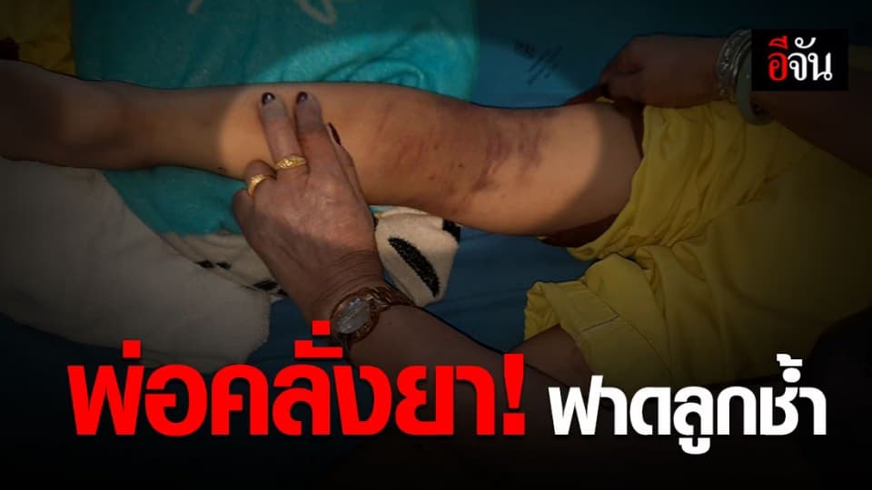 เวทนาหนูน้อย 8 ขวบ ถูกพ่อคลั่งยาฟาดจนช้ำ