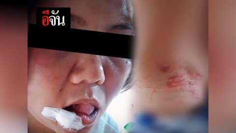 ช้ำเกินทน! ถูกสามีทำร้ายร่างกายจนบาดเจ็บหนัก