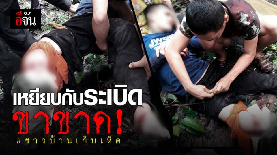 หนุ่ม ชาวศรีสะเกษ เหยียบกับระเบิด ขาขาด ขณะเข้าป่า เก็บเห็ด