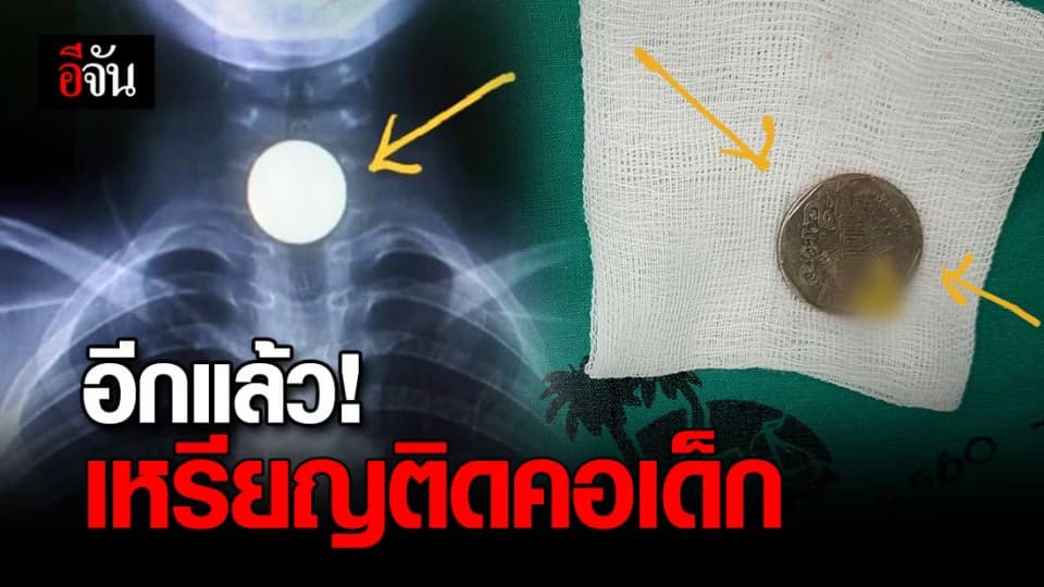 อุทาหรณ์ เหรียญติดคอ เด็ก 6 ขวบ หวิด หลอดอาหาร ทะลุ
