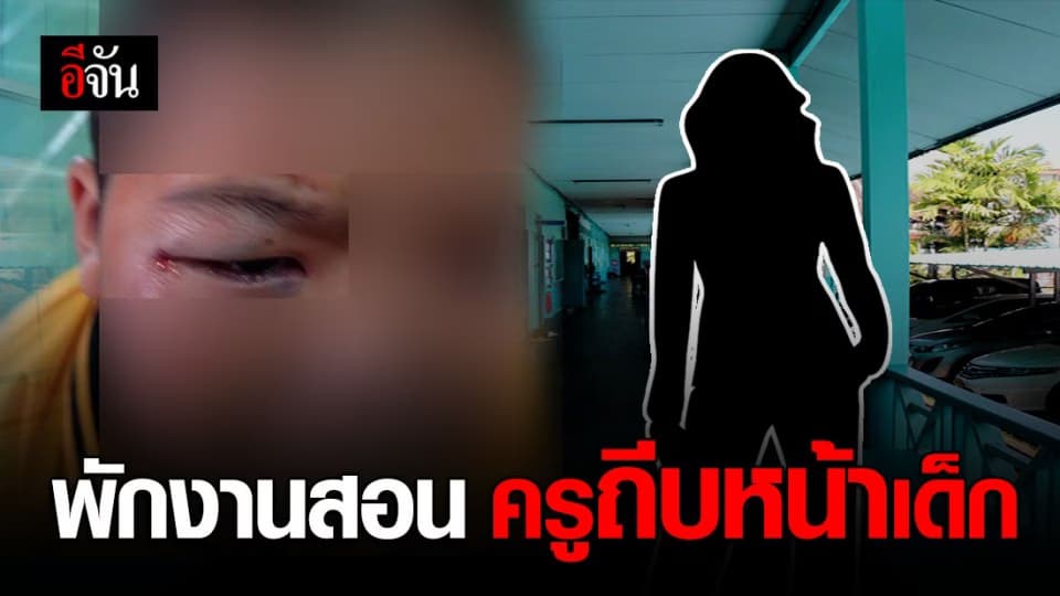 คืบหน้า ครูอนุบาล “ ถีบหน้าเด็ก 5 ขวบ ” หน้าบวมช้ำ สุดทรมาน