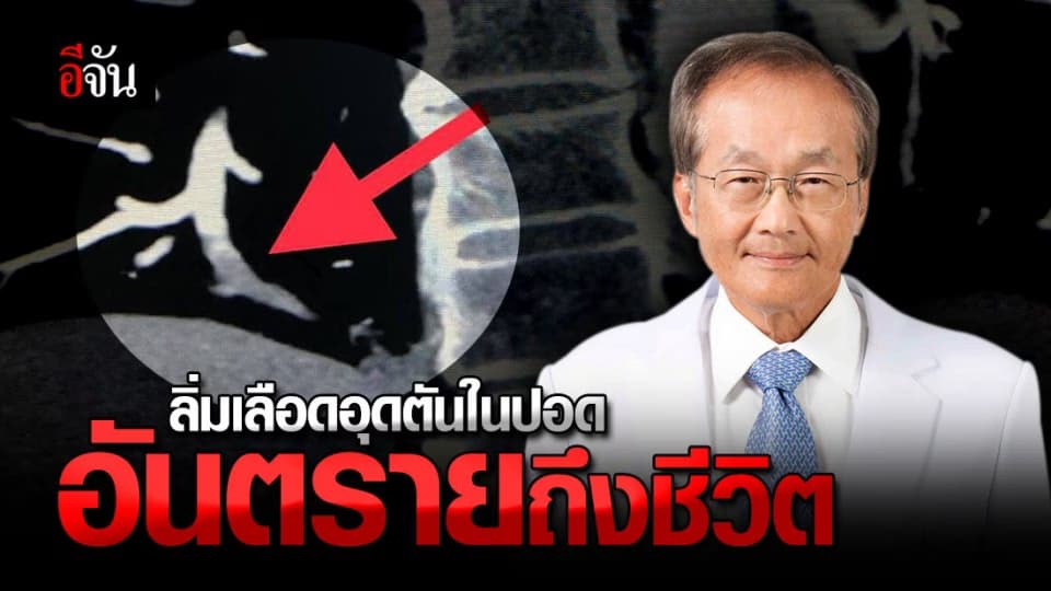 ลิ่มเลือดอุดตันในปอด ภัยเงียบสุดอันตราย ถึงตายหากไม่รีบรักษา