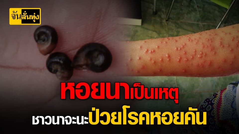 ชาวนา จะนะ ผื่นขึ้น กว่า 200 คน สาเหตุมาจาก หอยคัน ในนา