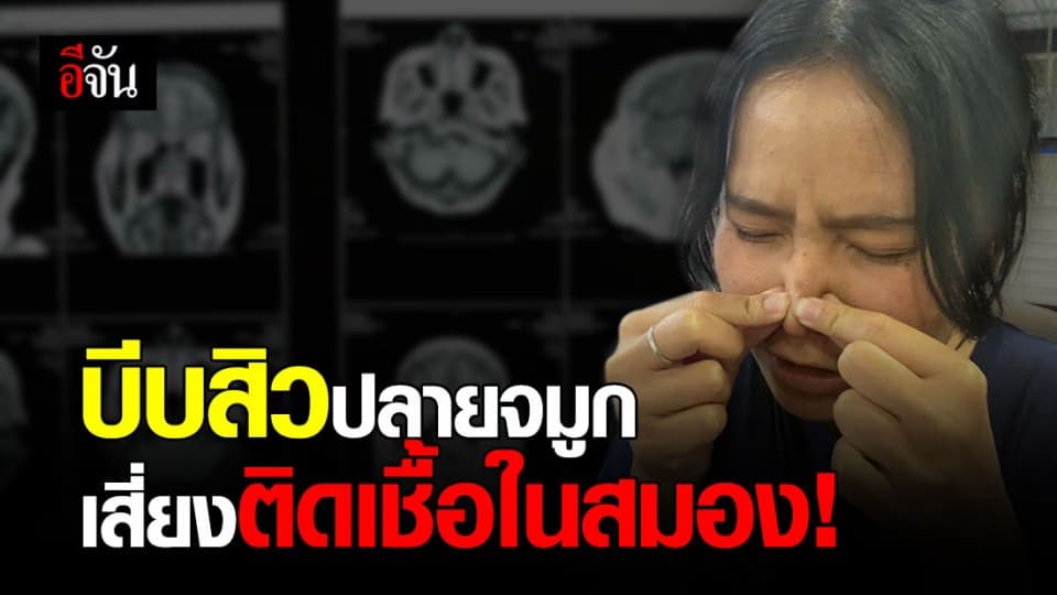 ระวัง ! บีบสิวปลายจมูก เสี่ยง ติดเชื้อในสมอง