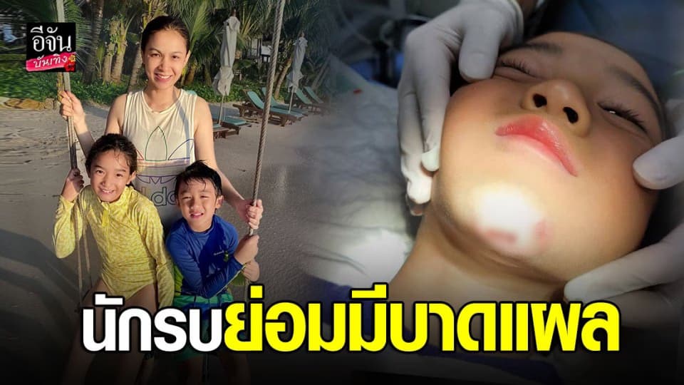 น้องณดล ลูกชายคนเล็กของคุณแม่ กบ สุวนันท์ ลื่นคางแตก