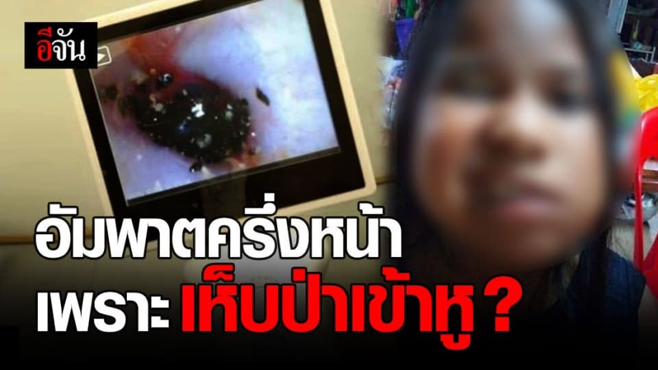 เตือนภัย ! เห็บป่าเข้าหู ด.ญ. 9 ขวบ ทำอัมพาตครึ่งหน้า เเก้วหูอักเสบ