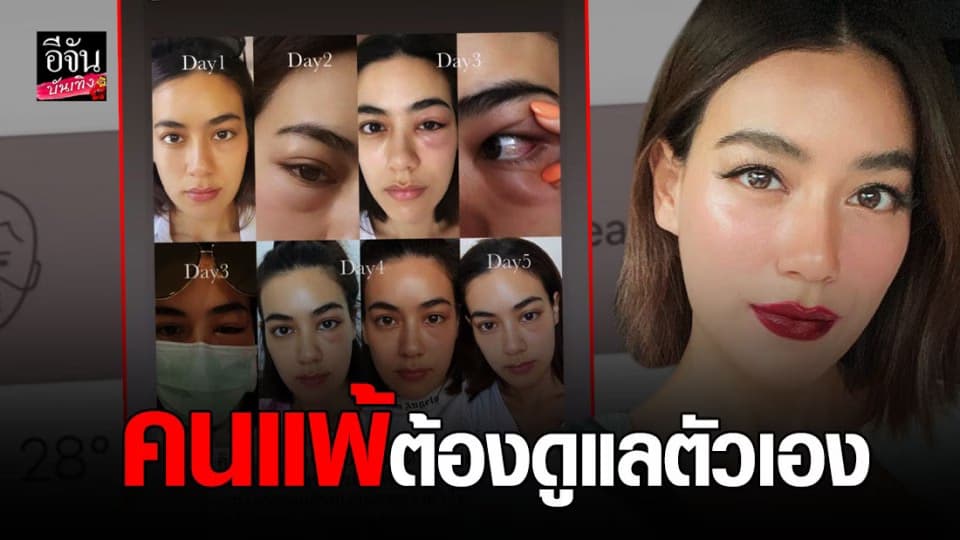 คิมเบอลี่ เตือนเป็นอุทาหรณ์ คนแพ้ต้องดูแลตัวเอง