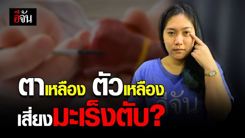 ข่าวจริง ตาเหลือง ตัวเหลือง เป็นสัญญาณเตือนมะเร็งตับ