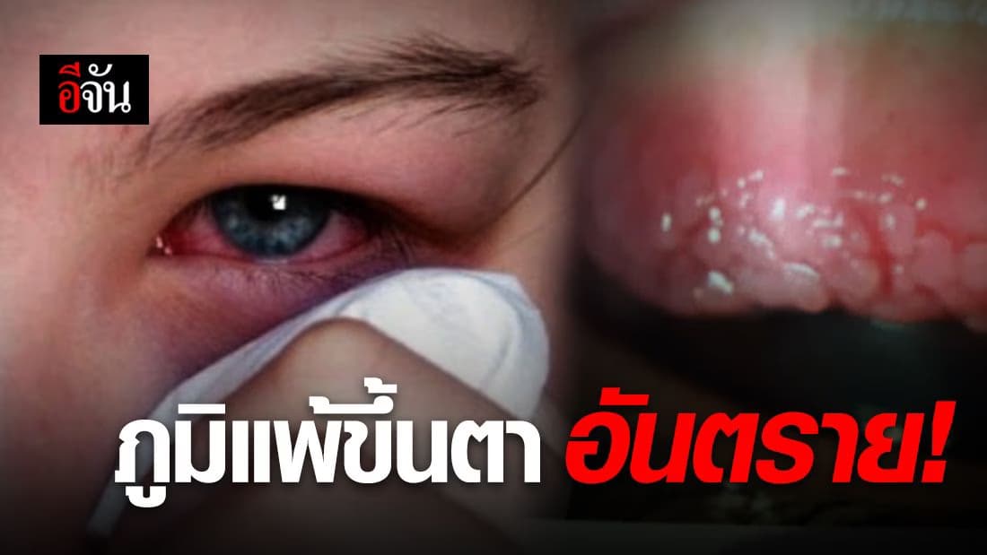 เคืองตา คันตา อย่าปล่อยไว้นาน โรคภูมแพ้ขึ้นตา อันตราย