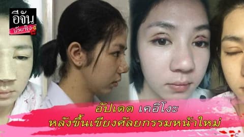 อัปเดต เคอิโงะ หลังขึ้นเขียงศัลยกรรมหน้าใหม่