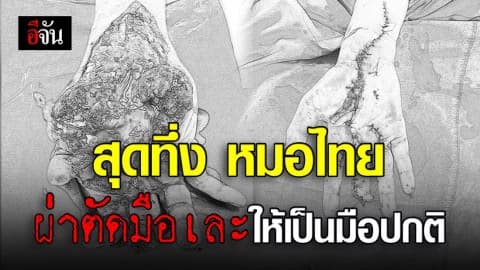 อย่าเพิ่งสิ้นศรัทธาในหมอไทย!!! หมอปิง โชว์ฝีมือ ผ่าตัดมือเละกลับเป็นมือปกติ ภายในเวลา 6 ชั่วโมง