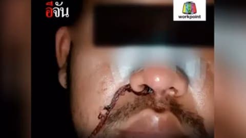 เปิดใจ หนุ่มทำศัลยกรรมจมูกทะลุ