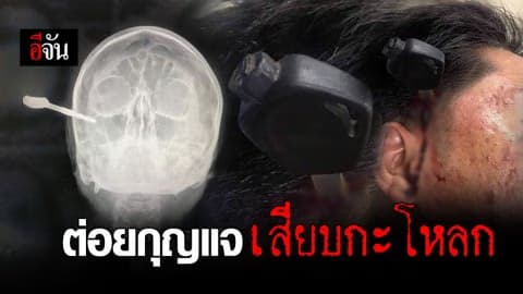 หวาดเสียว! หนุ่มถูกต่อย กุญแจรถเสียบคาขมับ