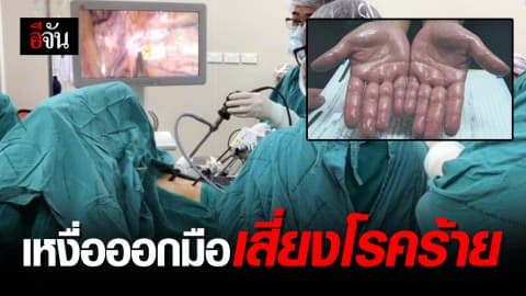 แค่เหงื่อออกมือ อาจเสี่ยงต่อโรคร้าย