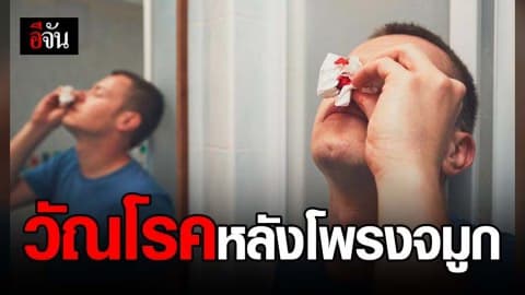 แพทย์เผย วัณโรคหลังโพรงจมูก คนที่ครอบครัวมีประวัติโรคนี้ เสี่ยงเป็นสูง