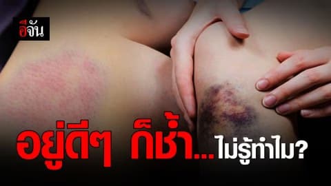 อยู่เฉยๆ ก็ช้ำ จ้ำเลือด บวกกับอาการแทรกซ้อนต้องพบแพทย์!